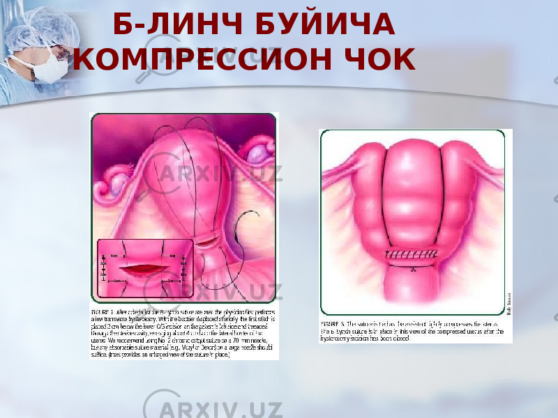  Б-ЛИНЧ БУЙИЧА КОМПРЕССИОН ЧОК 