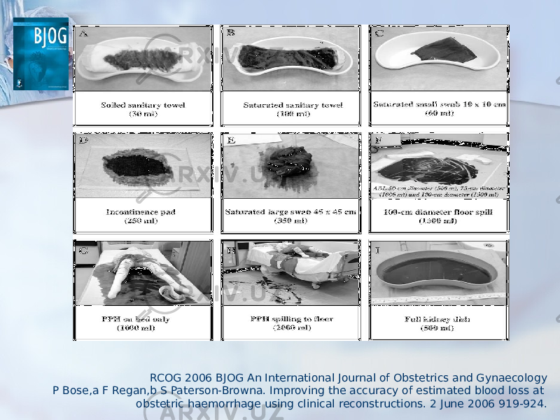 RCOG 2006 BJOG An International Journal of Obstetrics and Gynaecology P Bose,a F Regan,b S Paterson-Browna. Improving the accuracy of estimated blood loss at obstetric haemorrhage using clinical reconstructions. 2 June 2006 919-924. 