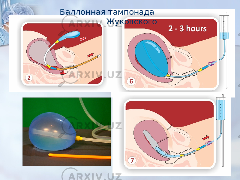 Баллонная тампонада Жуковского 