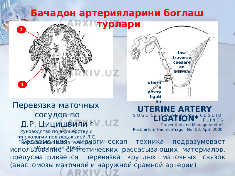 Перевязка маточных сосудов по Д.Р. Цицишвили * Руководство по акушерству и гинекологии под редакцией Л.С. Персианинова (Издательства «Медицина», 1964) uterin e artery ligati on UTERINE ARTERY LIGATION* low traverse caesare an incisionБачадон артерияларини боглаш турлари S O G C C L I N I C A L P R AC T I C E G U I D E L I N E S Prevention and Management of Postpartum Haemorrhage No. 88, April 2000 * Современная хирургическая техника подразумевает использование синтетических рассасывающих материалов, предусматривается перевязка круглых маточных связок (анастомозы маточной и наружной срамной артерии) 