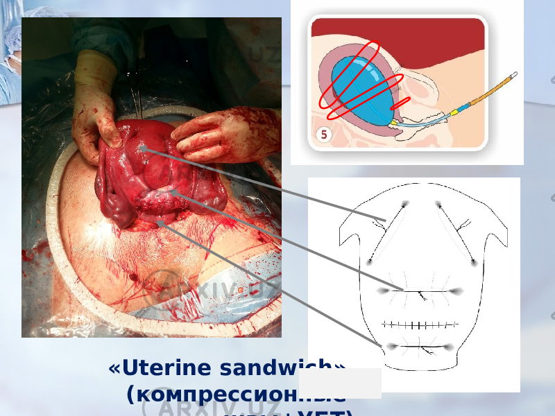 «Uterine sandwich» (компрессионные швы+УБТ) 