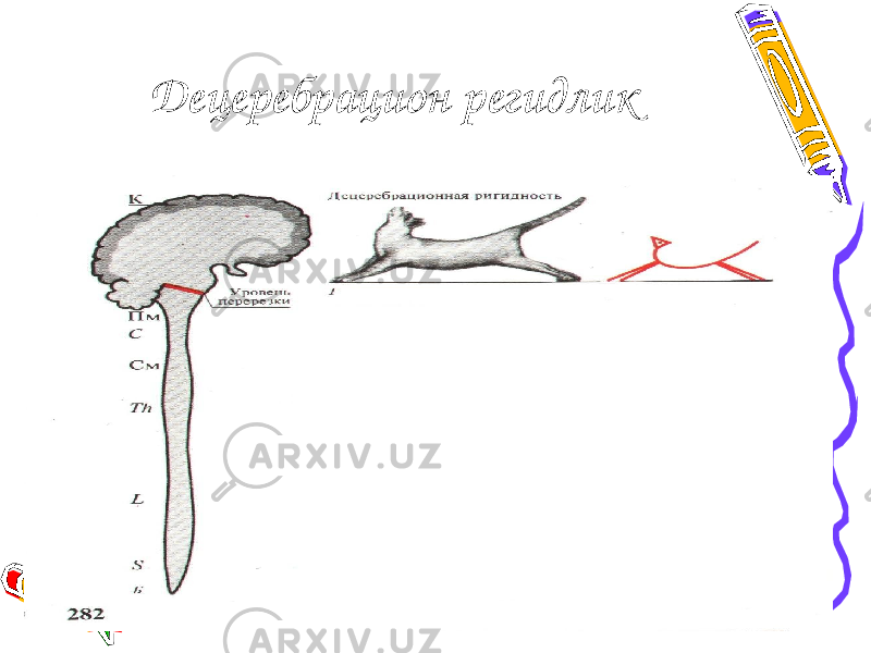 Децеребрацион регидлик 