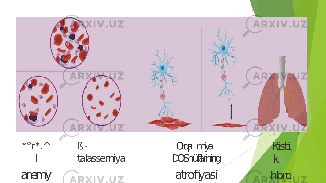 *°r*.^ I anemiy »si ß talassemiya Orqa miya DOShüflarining atrofiyasi Kisti k hbro z 
