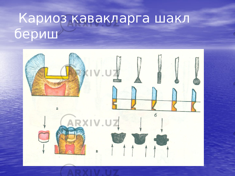  Кариоз кавакларга шакл бериш 