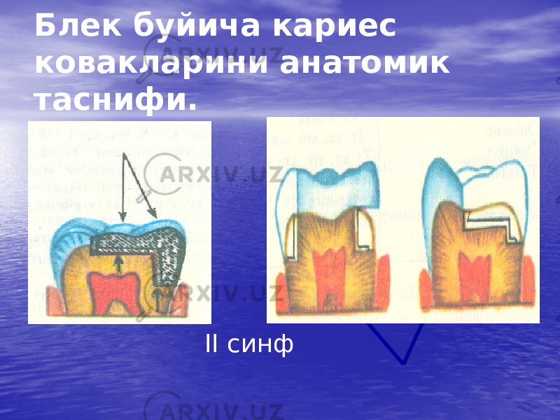 Блек буйича кариес ковакларини анатомик таснифи. II синф 