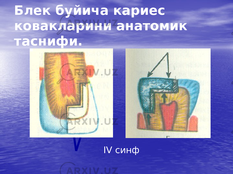 Блек буйича кариес ковакларини анатомик таснифи. IV синф 