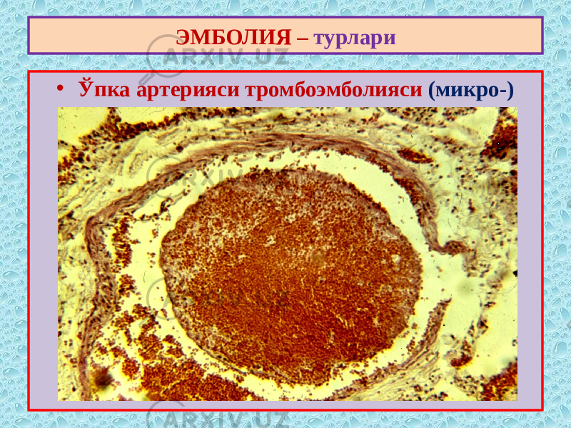 • Ўпка артерияси тромбоэмболияси (микро-)ЭМБОЛИЯ – турлари 