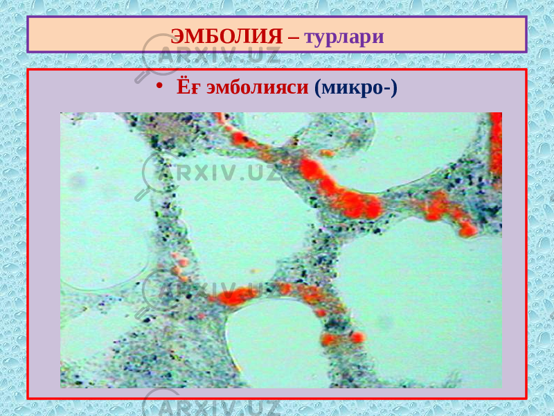 • Ёғ эмболияси (микро-)ЭМБОЛИЯ – турлари 