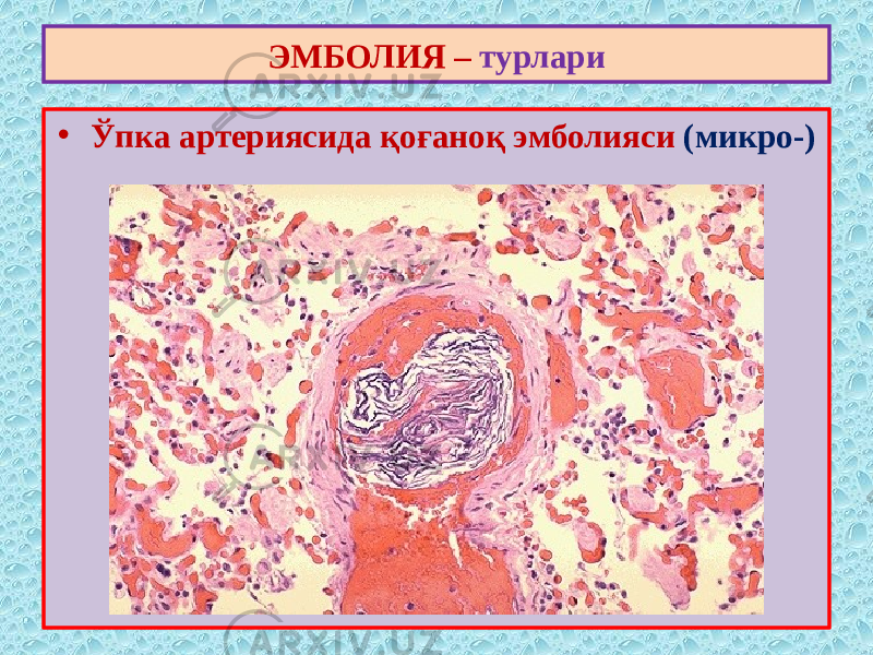 • Ўпка артериясида қоғаноқ эмболияси (микро-)ЭМБОЛИЯ – турлари 