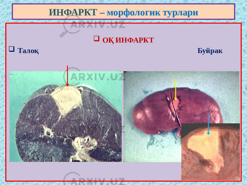  ОҚ ИНФАРКТ  Талоқ Буйрак ИНФАРКТ – морфологик турлари 