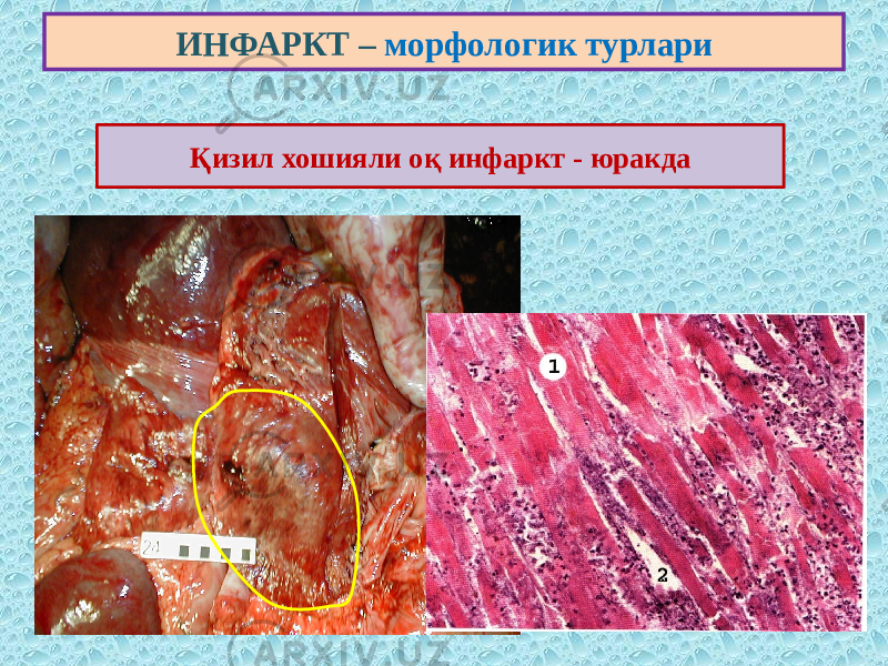 ИНФАРКТ – морфологик турлари Қизил хошияли оқ инфаркт - юракда 