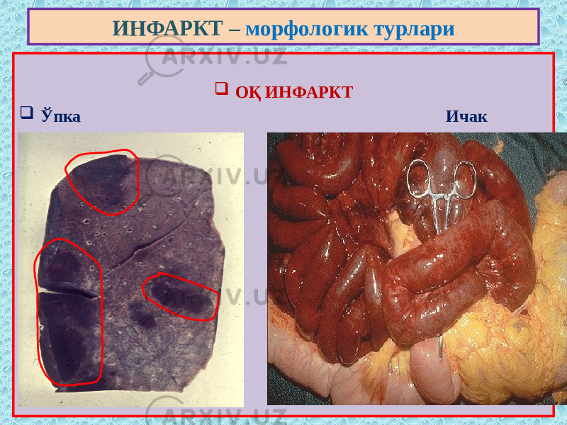  ОҚ ИНФАРКТ  Ўпка Ичак ИНФАРКТ – морфологик турлари 