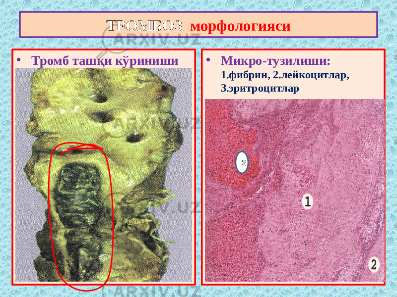 • Тромб ташқи кўриниши • Микро-тузилиши: 1.фибрин, 2.лейкоцитлар, 3.эритроцитларТРОМБОЗ морфологияси 3 