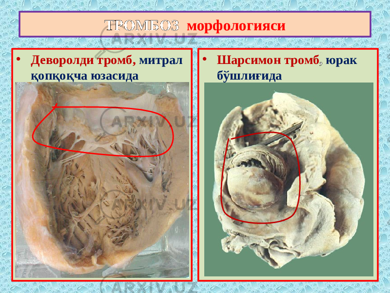 • Деворолди тромб, митрал қопқоқча юзасида • Шарсимон тромб , юрак бўшлиғидаТРОМБОЗ морфологияси 