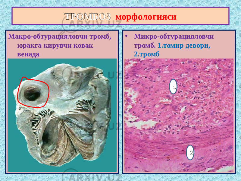 Макро-обтурацияловчи тромб, юракга кирувчи ковак венада • Микро-обтурацияловчи тромб. 1.томир девори, 2.тромбТРОМБОЗ морфологияси 1 2 