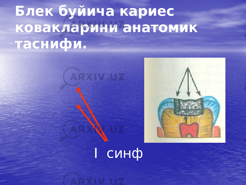 Блек буйича кариес ковакларини анатомик таснифи. I синф 