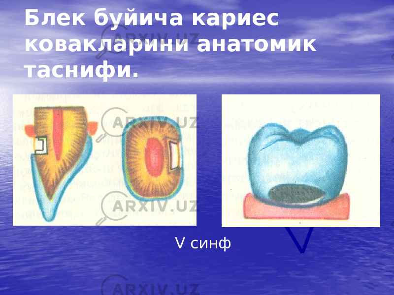 Блек буйича кариес ковакларини анатомик таснифи. V синф 