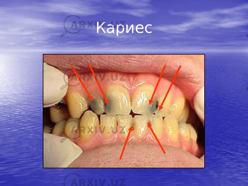 Кариес 