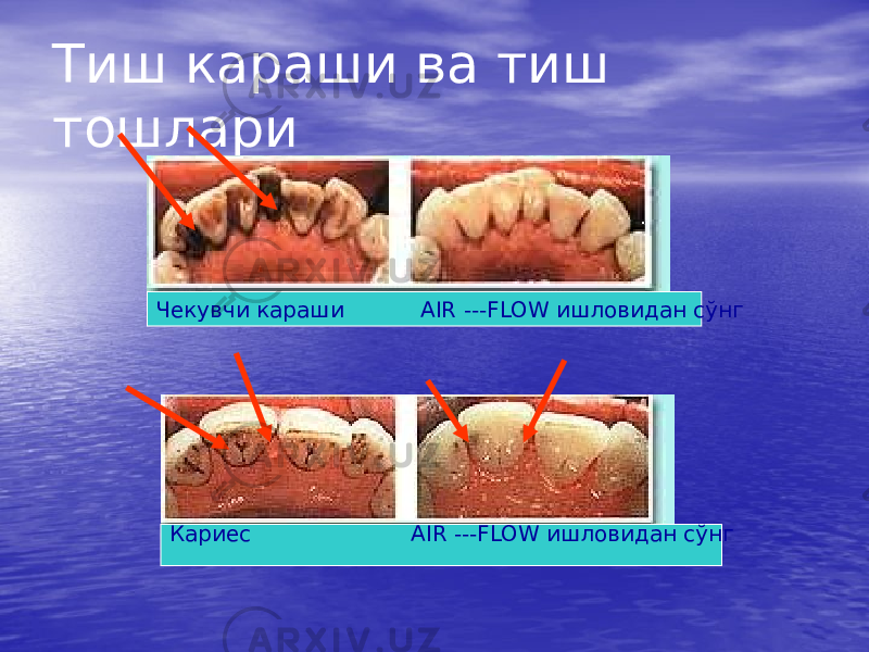 Тиш караши ва тиш тошлари Чекувчи караши AIR ---FLOW ишловидан сўнг Кариес AIR ---FLOW ишловидан сўнг 