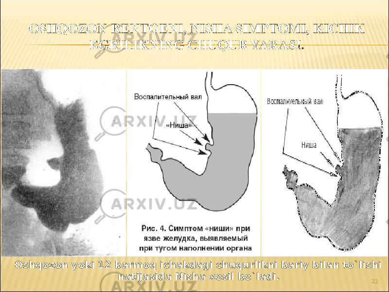 22Oshqozon yoki 12 barmoq ichakdagi chuqurlikni bariy bilan to`lishi natijasida Nisha xosil bo`ladi. 