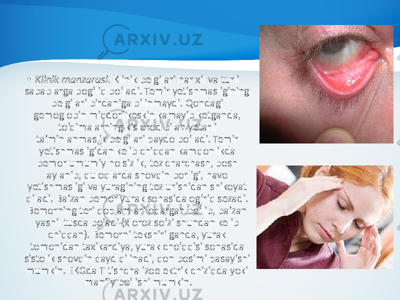 • Klinik manzarasi. Klinik belgilari har xil va turli sabablarga bog‘liq bo‘ladi. Temir yetishmasligining belgilari birdaniga bilinmaydi. Qondagi gemoglobin miqdori keskin kamayib ketganda, to‘qimalarning kislorod bilan yetarli ta’minlanmaslik belgilari paydo bo‘ladi. Temir yetishmasligidan kelib chiqqan kamqonlikda bemor umumiy holsizlik, tez charchash, bosh aylanib, quloqlarda shovqin borligi, havo yetishmasligi va yuragining tez urishidan shikoyat qiladi. Ba’zan bemor yurak sohasida og‘riq sezadi. Bemorning teri qoplamlari oqargan bo‘lib, ba’zan yashil tusda boiadi (xloroz so‘zi shundan kelib chiqqan). Bemorni tekshirilganda, yurak tomonidan taxikardiya, yurak cho‘qqisi sohasida sistolik shovqin qayd qilinadi, qon bosimi pasayishi mumkin. EKGda T tishcha izoelektrik chiziqda yoki manfiy bo‘lishi mumkin. 