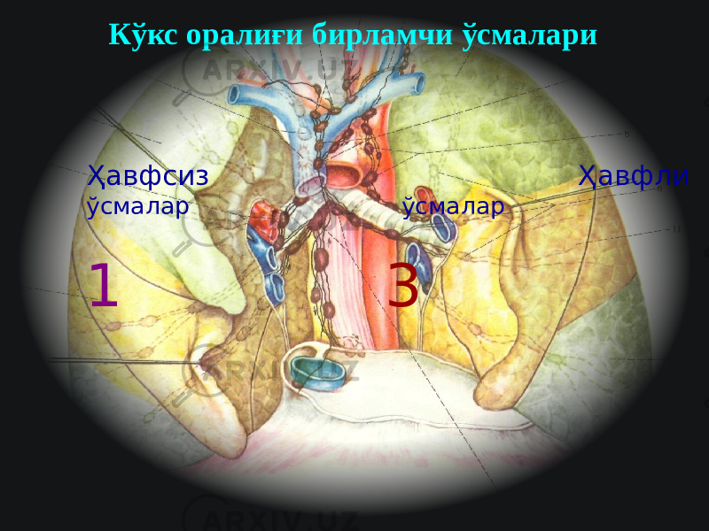 35Кўкс оралиғи бирламчи ўсмалари Ҳавфсиз Ҳавфли ўсмалар ўсмалар 1 3 