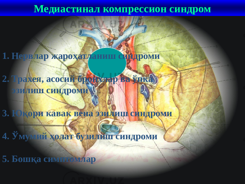 38Медиастинал компрессион синдром 1. Нервлар жароҳатланиш синдроми 2. Трахея, асосий бронхлар ва ўпка эзилиш синдроми 3. Юқори кавак вена эзилиш синдроми 4. Ўмумий ҳолат бузилиш синдроми 5. Бошқа симптомлар 