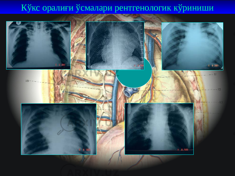 40Кўкс оралиғи ўсмалари рентгенологик кўриниши 