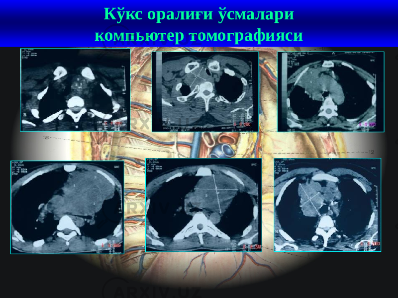 41Кўкс оралиғи ўсмалари компьютер томографияси 