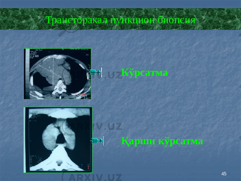 45Трансторакал пункцион биопсия Кўрсатма Қарши кўрсатма 
