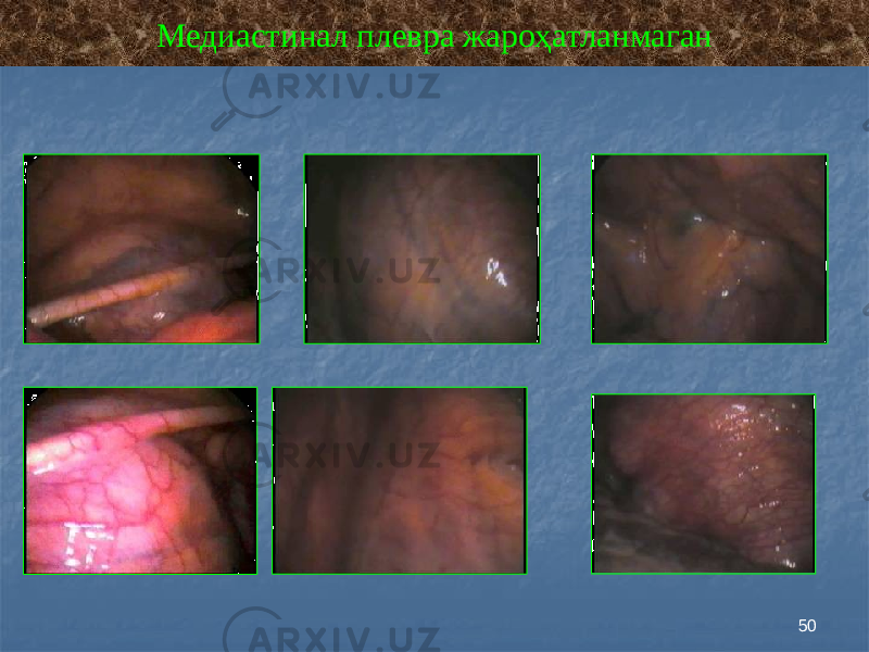 50Медиастинал плевра жароҳатланмаган 