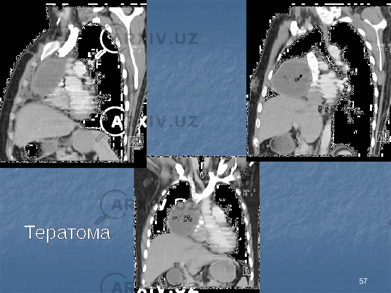 57Тератома 