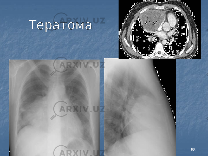 58Тератома 