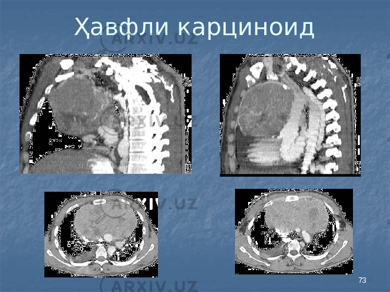 73Ҳавфли карциноид 