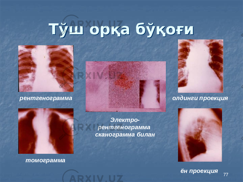 77Тўш орқа бўқоғиТўш орқа бўқоғи рентгенограмма олдинги проекция томограмма Электро- рентгенограмма сканограмма билан ён проекция 