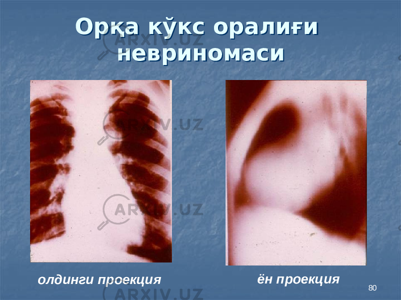 80Орқа кўкс оралиғи невриномасиОрқа кўкс оралиғи невриномаси олдинги проекция ён проекция 