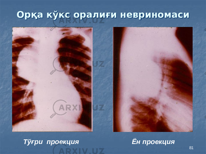 81Орқа кўкс оралиғи невриномасиОрқа кўкс оралиғи невриномаси Тўғри проекция Ён проекция 