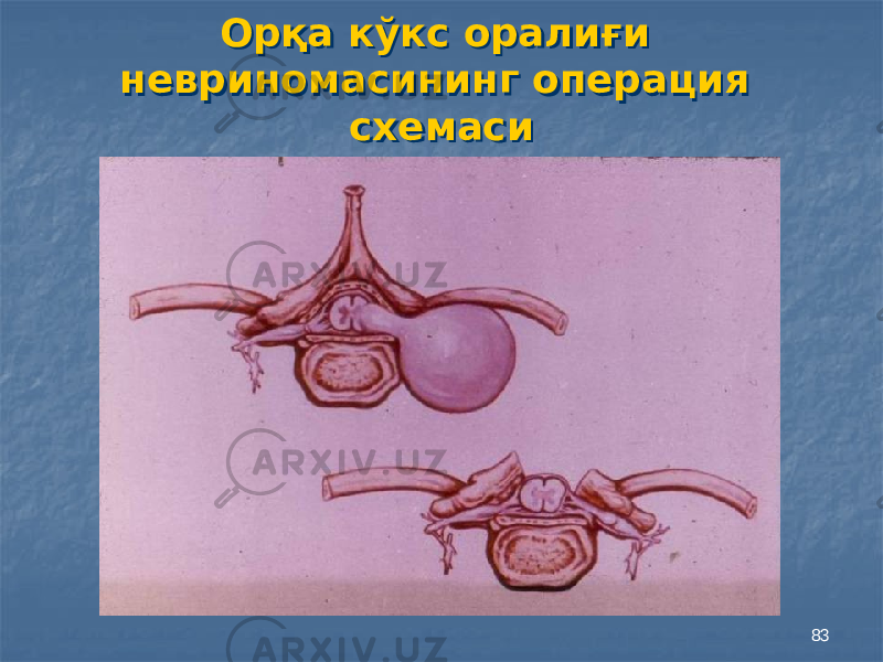 83Орқа кўкс оралиғи невриномасининг операция схемасиОрқа кўкс оралиғи невриномасининг операция схемаси 