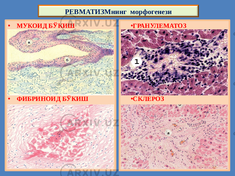 • МУКОИД БЎКИШ • ФИБРИНОИД БЎКИШ • ГРАНУЛЕМАТОЗ • СКЛЕРОЗРЕВМАТИЗМнинг морфогенези 