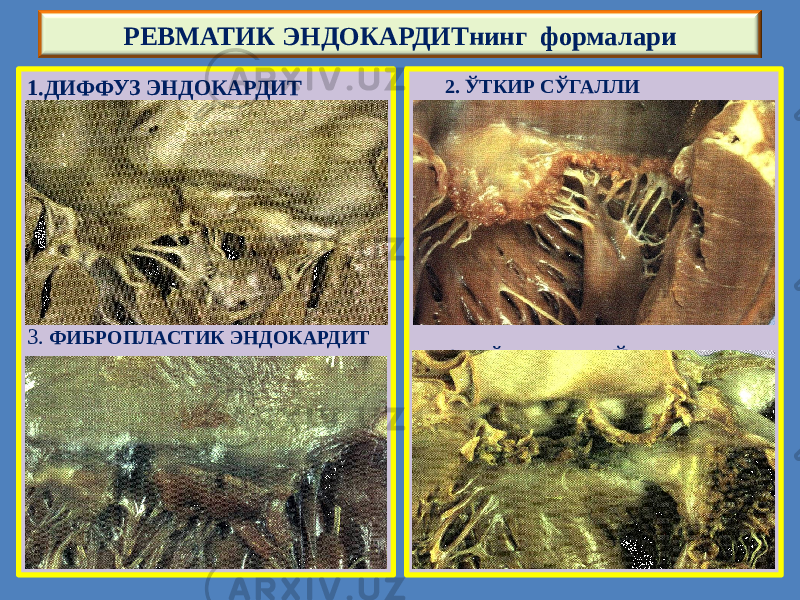 1.ДИФФУЗ ЭНДОКАРДИТ 3. ФИБРОПЛАСТИК ЭНДОКАРДИТ 2. ЎТКИР СЎГАЛЛИ ЭНДОКАРДИТ 4.ҚАЙТАЛАМА СЎГАЛЛИ ЭНДО- ТРЕВМАТИК ЭНДОКАРДИТнинг формалари 