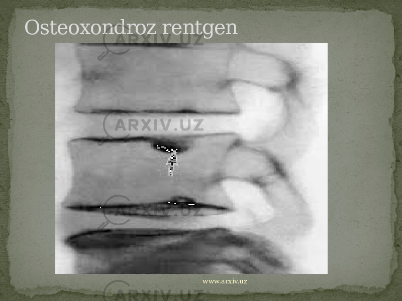 Osteoxondroz rentgen www.arxiv.uz 