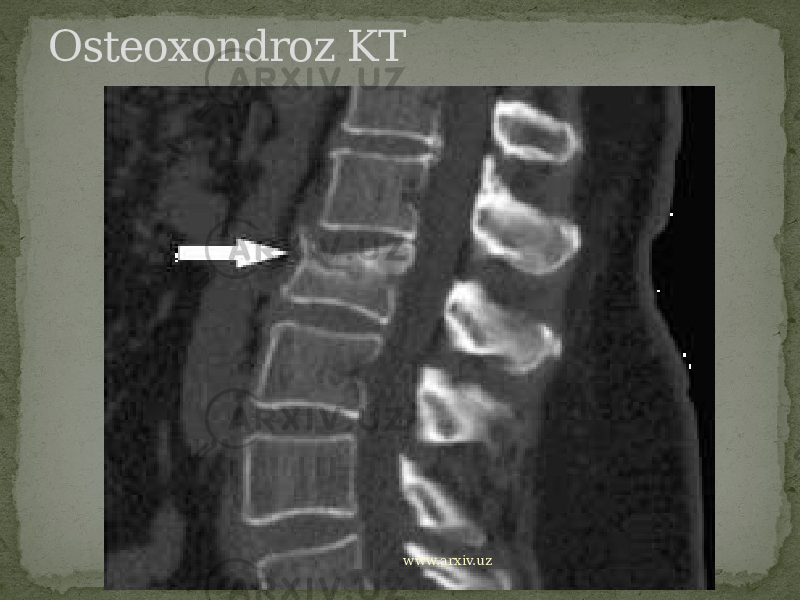 Osteoxondroz KT www.arxiv.uz 