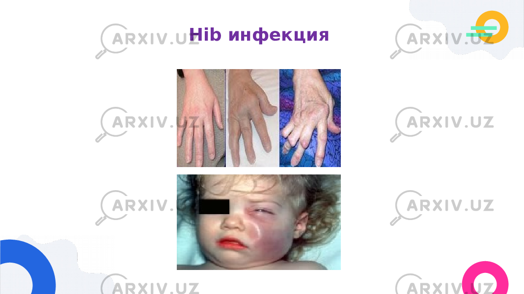 Hib инфекция 