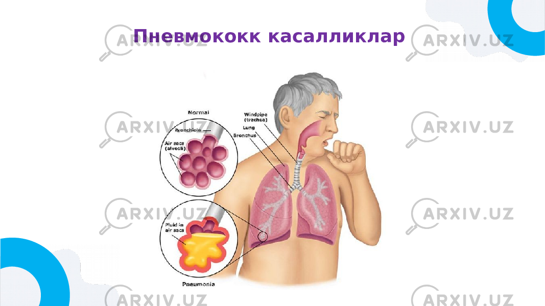 Пневмококк касалликлар 