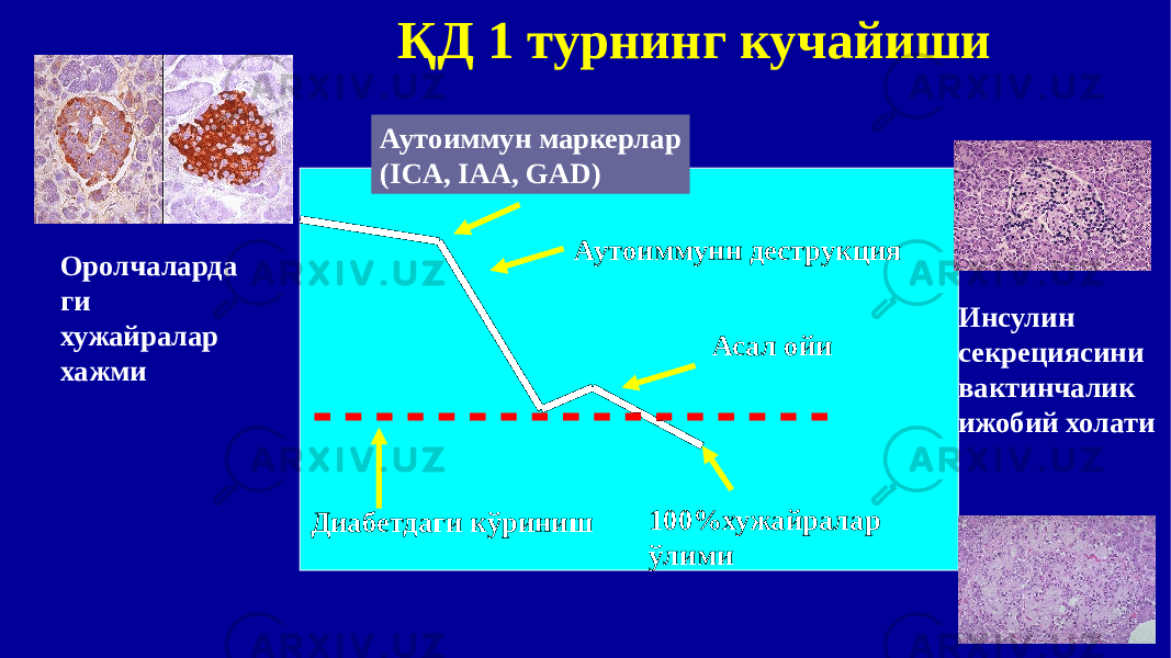 ҚД 1 турнинг кучайиши Аутоиммунн деструкция Диабетдаги кўриниш Асал ойи 100%хужайралар ўлимиАутоиммун маркерлар (ICA, IAA, GAD) Оролчаларда ги хужайралар хажми Инсулин секрециясини вактинчалик ижобий холати 