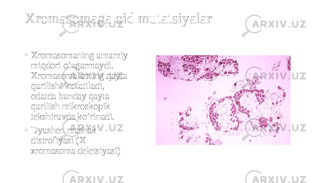 Xromasomaga oid mutatsiyalar • Xromasomaning umumiy miqdori o‘zgarmaydi. Xromasomalarning qayta qurilishi kuzatiladi, odatda bunday qayta qurilish mikroskopik tekshiruvda ko‘rinadi. • Dyushen mushak distrofiyasi (X- xromasoma deletsiyasi) 