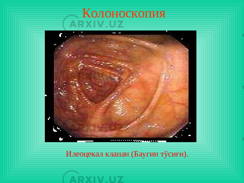Колоноскопия И леоцекал клапан (Баугин тўсиғи ). 