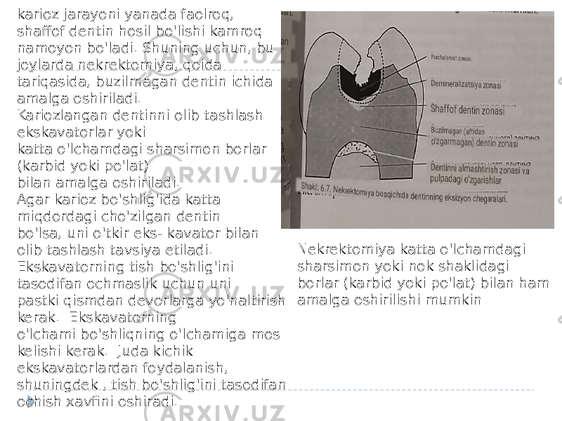 karioz jarayoni yanada faolroq, shaffof dentin hosil bo&#39;lishi kamroq namoyon bo&#39;ladi. Shuning uchun, bu joylarda nekrektomiya, qoida tariqasida, buzilmagan dentin ichida amalga oshiriladi. Kariozlangan dentinni olib tashlash ekskavatorlar yoki katta o&#39;lchamdagi sharsimon borlar (karbid yoki po&#39;lat) bilan amalga oshiriladi. Agar karioz bo&#39;shlig&#39;ida katta miqdordagi cho&#39;zilgan dentin bo&#39;lsa, uni o&#39;tkir eks- kavator bilan olib tashlash tavsiya etiladi. Ekskavatorning tish bo&#39;shlig&#39;ini tasodifan ochmaslik uchun uni pastki qismdan devorlarga yo&#39;naltirish kerak. Ekskavatorning o&#39;lchami bo&#39;shliqning o&#39;lchamiga mos kelishi kerak. Juda kichik ekskavatorlardan foydalanish, shuningdek , tish bo&#39;shlig&#39;ini tasodifan ochish xavfini oshiradi. Nekrektomiya katta o&#39;lchamdagi sharsimon yoki nok shaklidagi borlar (karbid yoki po&#39;lat) bilan ham amalga oshirilishi mumkin 