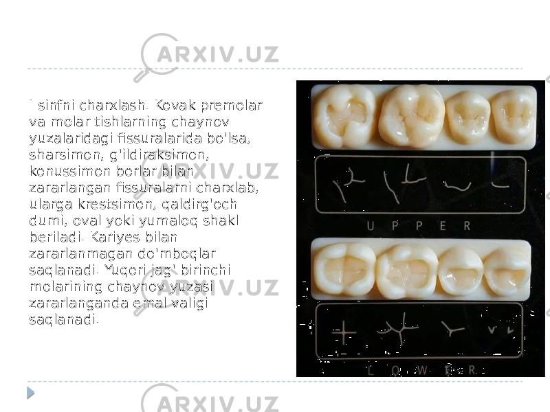 I sinfni charxlash. Kovak premolar va molar tishlarning chaynov yuzalaridagi fissuralarida bo&#39;lsa, sharsimon, g&#39;ildiraksimon, konussimon borlar bilan zararlangan fissuralarni charxlab, ularga krestsimon, qaldirg&#39;och dumi, oval yoki yumaloq shakl beriladi. Kariyes bilan zararlanmagan do&#39;mboqlar saqlanadi. Yuqori jag&#39; birinchi molarining chaynov yuzasi zararlanganda emal valigi saqlanadi. 