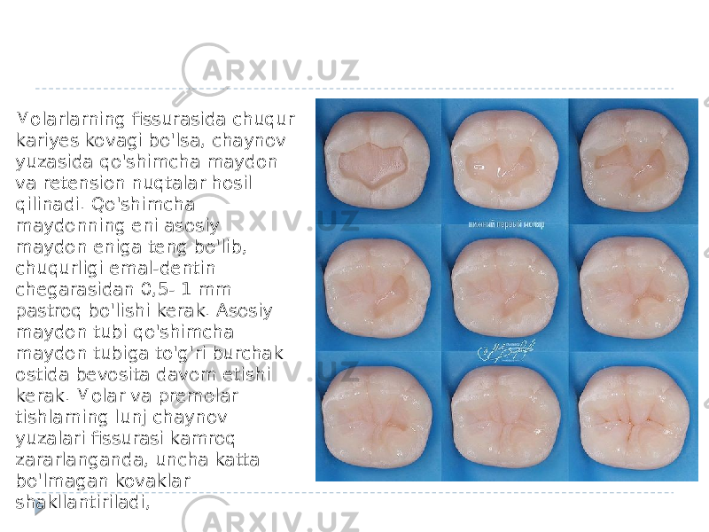 Molarlarning fissurasida chuqur kariyes kovagi bo&#39;lsa, chaynov yuzasida qo&#39;shimcha maydon va retension nuqtalar hosil qilinadi. Qo&#39;shimcha maydonning eni asosiy maydon eniga teng bo&#39;lib, chuqurligi emal-dentin chegarasidan 0,5- 1 mm pastroq bo&#39;lishi kerak. Asosiy maydon tubi qo&#39;shimcha maydon tubiga to&#39;g&#39;ri burchak ostida bevosita davom etishi kerak. Molar va premolar tishlarning lunj chaynov yuzalari fissurasi kamroq zararlanganda, uncha katta bo&#39;lmagan kovaklar shakllantiriladi, 